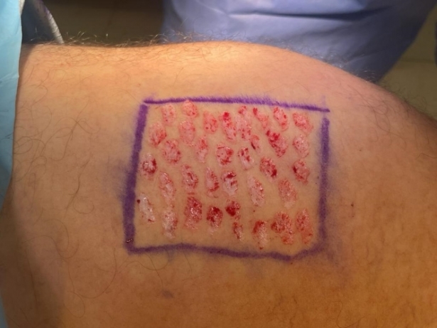 Sello epidermis (JUNTA) Sello epidermis (JUNTA)